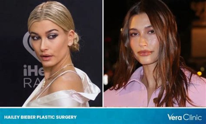 Did Hailey Bieber Ever Get Plastic Surgery? Kanye West Alleges She Got a Nose Job